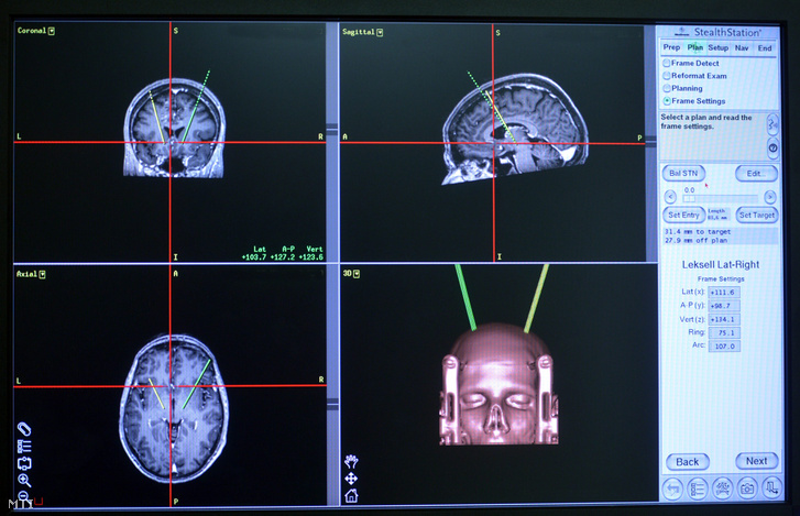 Agyi defibrillátor vethet véget az epilepsziás rohamoknak