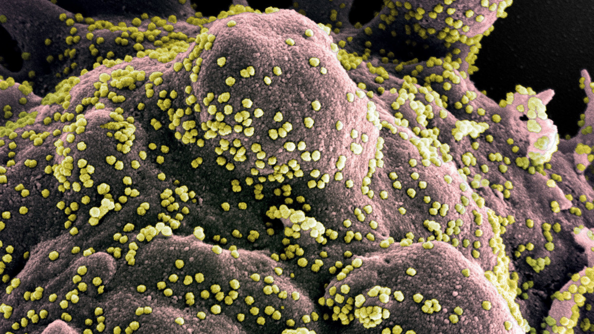 Az amerikai Allergiás és Fertőző Betegségek Országos Intézetében (NIAID) készült, és az amerikai Országos Egészségügyi Intézetek (NIH) által elérhetővé vált, dátumozatlan elektronmikroszkópos, utószínezett kép a SARS-CoV-2 nevű koronavírusról (sárga), és a kórokozó által megtámadott, pusztuló emberi sejtekről (szürke). A világjárványt okozó vírus mintáját egy betegtől vették.