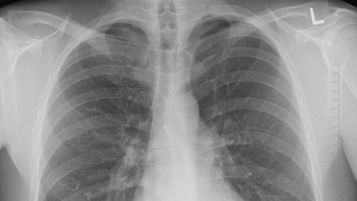 Radák Zsolt: a betegek egy részénél a tüdőkapacitás ötödével végez a koronavírus