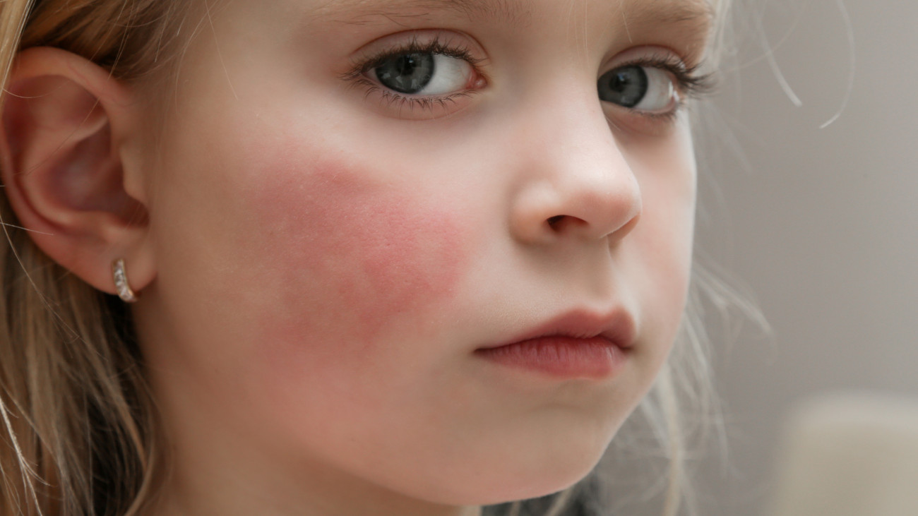 Redness on childs cheeks caused by eczema, dry skin or allergy