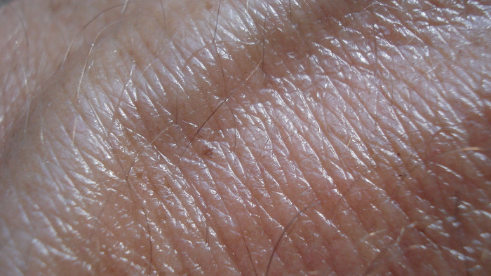 Feleslegessé teheti a bőrátültetést egy új technológia