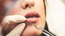Egy ikerpár arca a jó példa rá, mit tesz húsz évnyi botox